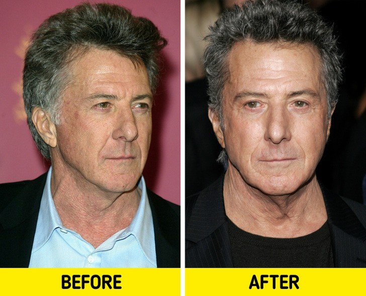 Dustin Hoffman: zabieg brwi