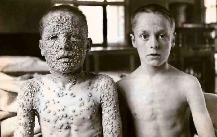 Dva chlapci vystaveni viru neštovic.  Jeden byl očkovaný, druhý ne.
