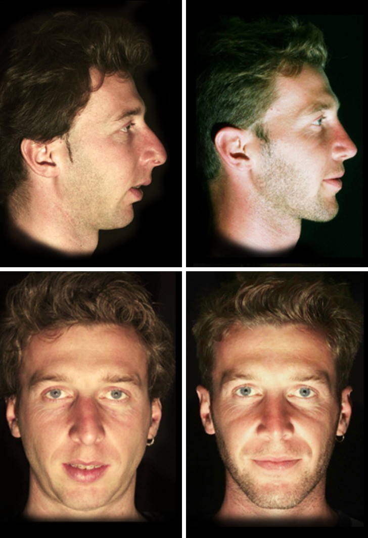2. Rezultat operacji nosa i podbródka, a także liftingu twarzy