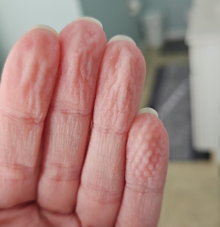 "Mój mały palec po wzięciu prysznica dzień po tym, jak go oparzyłam."