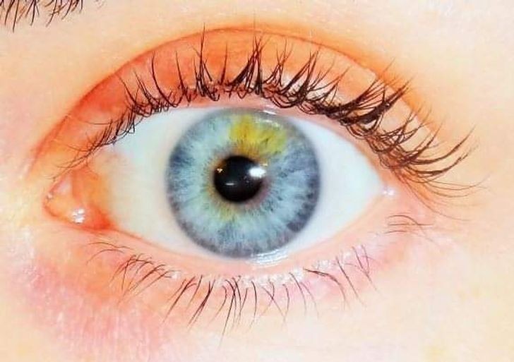 "Częściowa heterochromia. Uwielbiam moje lewe oko."