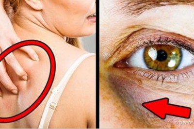 12 objawów sygnalizujących, że spożywasz za dużo cukru! To może być bardzo niebezpieczne dla zdrowia! 