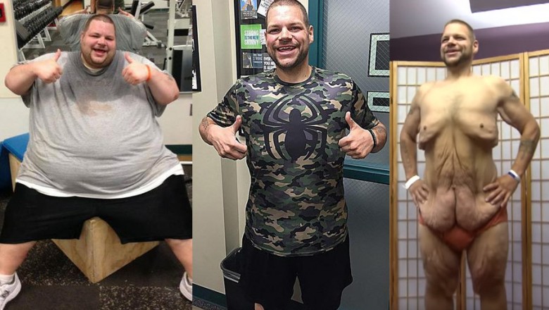 190 kg w 714 dni! Dzięki ciężkiej pracy osiągnoł coś niesamowitego ale zobacz jego skórę!