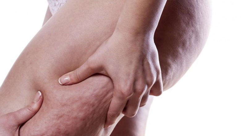 6 ważnych faktów na temat celolitu które pomogą Ci ułatwić walkę z niechcianym problemem!