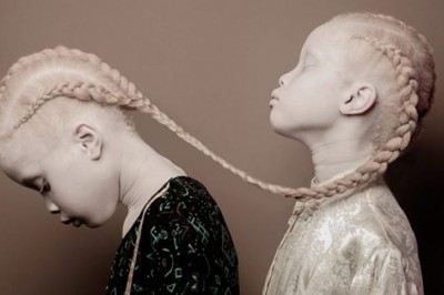 Bliźniaczki cierpiące na albinizm pozują do niezwykłej sesji! Jednak to wygląd 3 siostry budzi emocje!