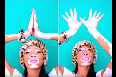 Była wytykana przez swoją skórę. Teraz jej skóra uczyniła ją gwiazdą! 