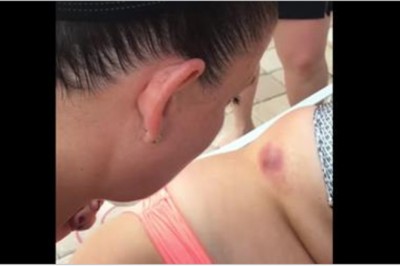 Dosłownie widać jak z niej to wystrzela! Zobacz jak kończy się wyciskanie malutkiego pryszcza na basenie!