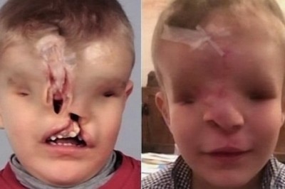 Dziecko bez oczu i nosa odzyskało twarz. Cud medycyny.