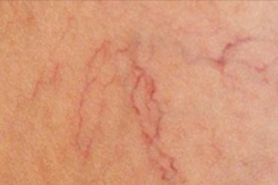 Lekarstwo na nieestetyczne pajączki na nogach masz w swoich domu! Mało kto o nim wie! 