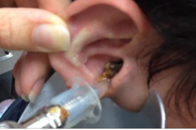 Lekarz był w szoku widząc co wypływa! Takiego efektu płukania ucha się nie spodziewali!