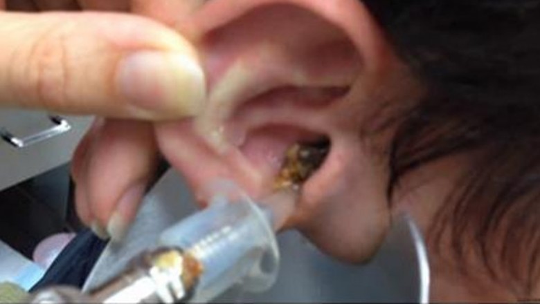 Lekarz był w zszokowany widząc co wypływa! Takiego efektu płukania ucha nie mógł przewidzieć!