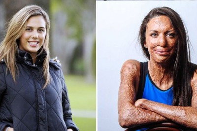 Ma spalone 65% ciała! Zapytała chłopaka 