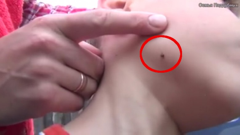 Mama zobaczyła wbitego kleszcza w buzie swojego dziecka! Sposób w jaki go wyciągnęła jest genialny!