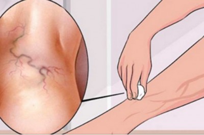 Pozbądź się żylaków na nogach dzięki temu naturalnemu olejkowi! Kupisz go w każdej aptece! 