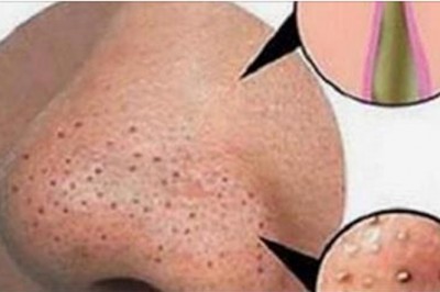 Próbujesz ciągle pozbyć się zaskórników?! Ta genialna metoda sprawdzi się skutecznie u każdego!