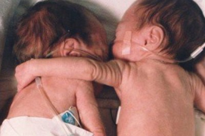 Tuż po porodzie siostra otacza ramieniem swoją umierającą bliźniaczkę! Lekarze nie mogli uwierzyć!