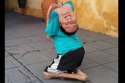 Urodził się z głową odpadającą od ciała! Lekarze nie dawali mu szans ale matczyna miłość była silniejsza!