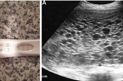 Widząc pozytywny test ciążowy bardzo się cieszy! Podczas USG lekarz zamiast dziecka dostrzega setki...