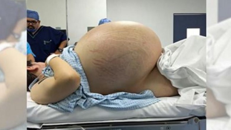 Wyglądała jak w ciąży z 5 raczkami! Gdy lekarze prześwietlili jej brzuch nie mogli uwierzyć co znaleźli! 