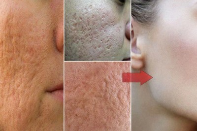 Wystarczą tylko te dwa składniki, żeby wygładzić pory na Twojej twarzy! Zrobisz to w domu!