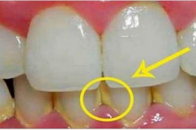 Zobacz jak usunąć kamień z zębów w 5 minut naturalnymi składnikami! Bez wizyty u dentysty!