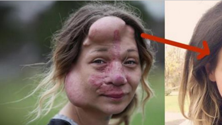 Żeby ratować jej życie musieli odciąć jej nos! To jak wygląda po operacji jest naprawdę niezwykłe! 