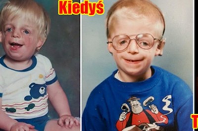 Rodzice zostawili go po urodzeniu widząc jak wygląda! Nie uwierzysz jak potoczyło się jego życie! 