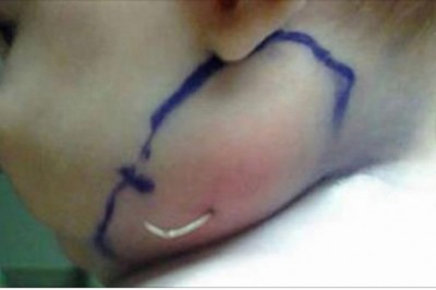 Ze spuchniętego policzka dziecka lekarz wyciąga coś zaskakującego! Nie mógł zrozumieć jak to się stało!