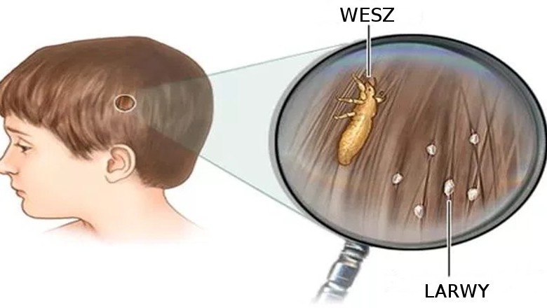Oto receptura, której nie zdradzi Ci  lekarz! Sprawdź jak szybko i tanio pozbyć się wszy!