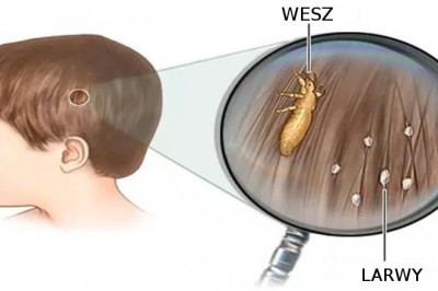 Oto receptura, której nie zdradzi Ci  lekarz! Sprawdź jak szybko i tanio pozbyć się wszy!