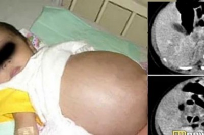 Lekarze myśleli, że w jej brzuchu rozwija się guz! To co zobaczyli w środku zupełnie ich zaskoczyło!