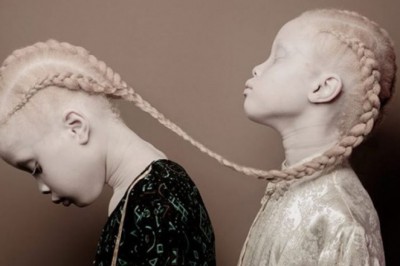 Bliźniaczki cierpiące na albinizm pozują do niezwykłej sesji! Ale to wygląd 3 siostry budzi emocje!