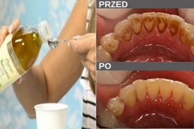 Zapomnij o nieświeżym oddechu, osadzie i bakteriach w ustach, przy pomocy tylko jednego składnika!