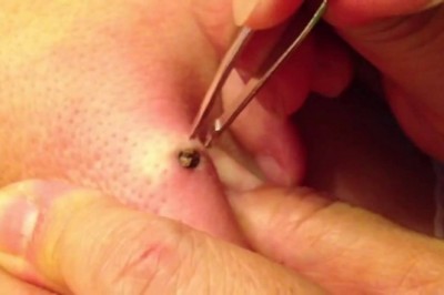 W końcu się odważyła wycisnąć 20 letniego wągra! Nie uwierzysz ile tego  było pod skórą!