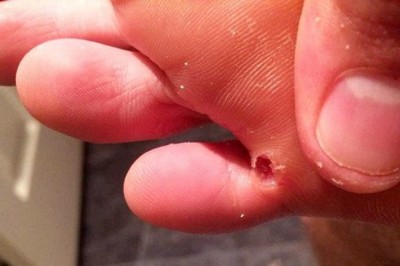 Jeśli zauważasz u siebie te objawy, to najprawdopodobniej w twoim organizmie zagnieździły się pasożyty! 