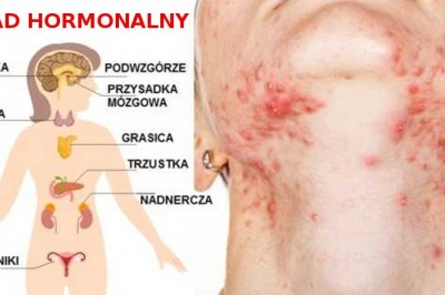 Te produkty spożywcze destrukcyjnie wpływają na Twój układ hormonalny i cerę! Unikaj ich w sklepie!