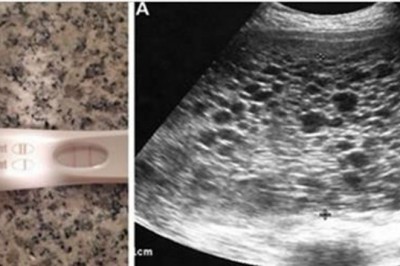 Sprawdzając test ciążowy bardzo się cieszy! Podczas USG lekarz zamiast dziecka dostrzega setki...