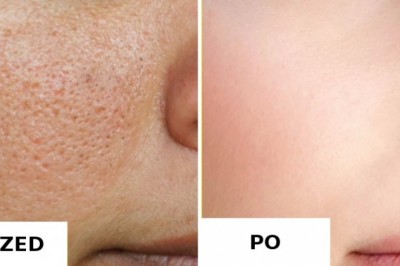 4 naturalne sposoby, żeby pozbyć się otwartych porów z twarzy! Skóra znów będzie nieskazitelna