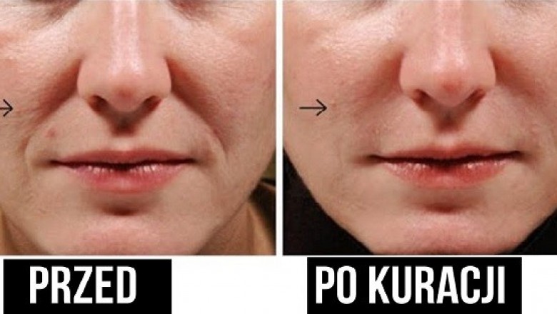 Dzięki tej skutecznej metodzie pozbyłam się zmarszczek mimicznych! To wszystko naturalne składniki!