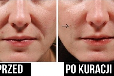 Dzięki tej skutecznej metodzie pozbyłam się zmarszczek mimicznych! To wszystko naturalne składniki! 