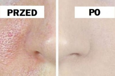 Masz problem z otwartymi porami na swojej cerze? 3 dniowa terapia pozwoli Ci się ich pozbyć!