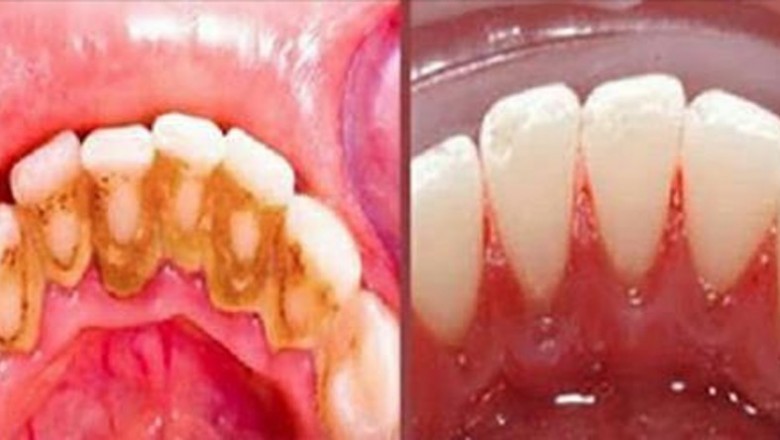 Babcia powtarzała, że ten prosty trik pozwala uniknąć dentysty! Nie wierzyłam dopóki nie spróbowałam sama!