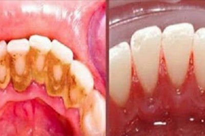 Babcia powtarzała, że ten prosty trik pozwala uniknąć dentysty! Nie wierzyłam dopóki nie spróbowałam sama!