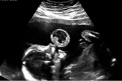 Mama myśli, że na USG widać jak jej maluch puszcza bańki! Wtedy lekarz przekazuję jej złe nowiny!