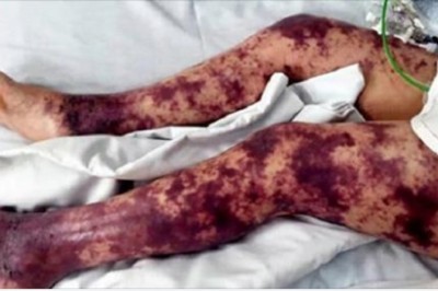 Ciało 7-letniej dziewczynki zaczynają pokrywać siniaki! Gdy mama orientuje się, co się dzieje jest już za późno! 