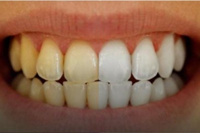 Zmieszał te dwa składniki i umył tym zęby! Efekt jest rewelacyjny i koniecznie muszę spróbować!