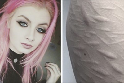 Żaden tatuażysta nie chciał zakryć blizn szpecących ciało tej 19-latki! Poza tym jednym!