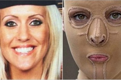 5 lat po ataku żrącą substancją zdecydowała się zdjąć maskę i pokazać światu swoją twarz!