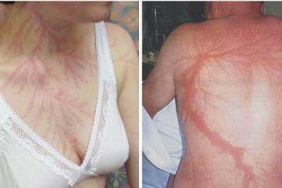 Ci ludzie przeżyli bezpośrednie uderzenie pioruna. Na ich skórze pozostały niesamowite ślady. 