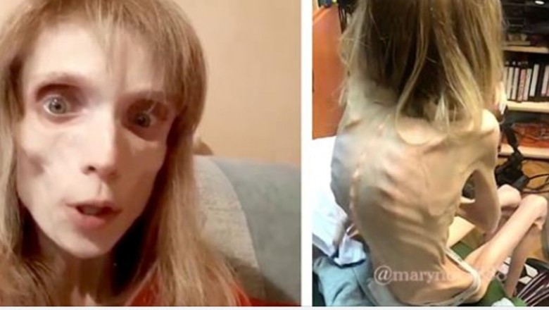 Mając 26 lat waży jedynie 17 kg. Jej dieta to kawałek banana i woda, bo nie może przełknąć nic więcej